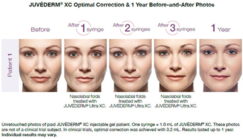 juvederm-before-and-after-service