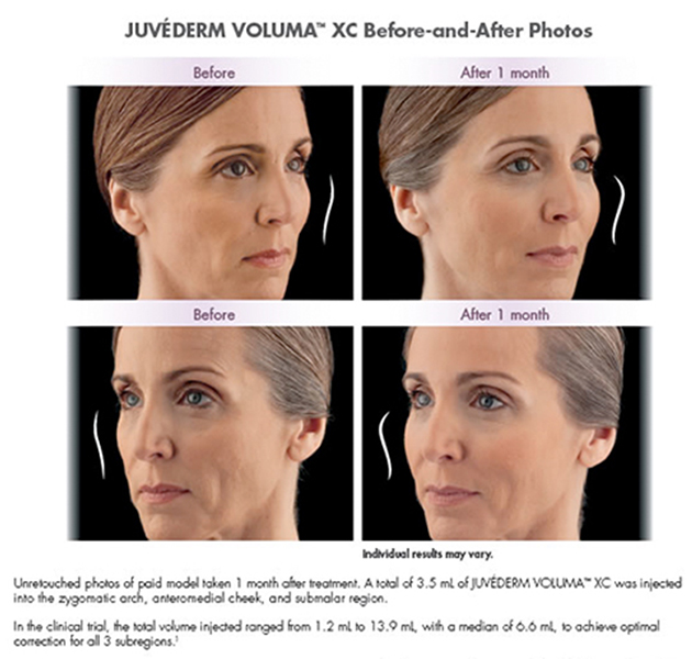 juvederm-voluma-before-and-after-face-place